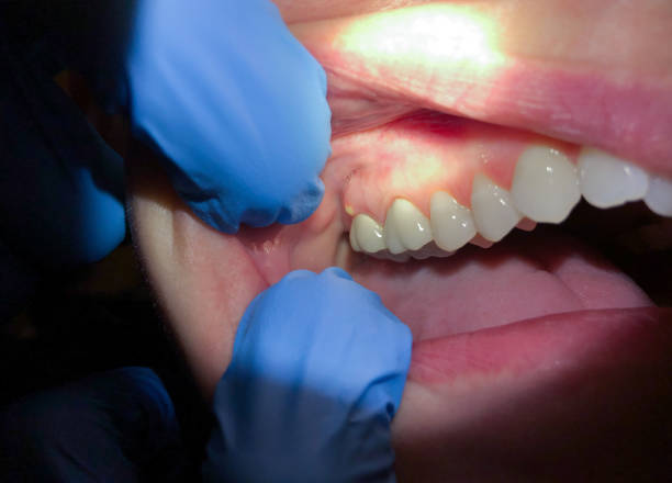 Best Emergency Wisdom Teeth Removal in Campti, LA